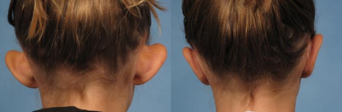 Before & After Otoplasty Case 262 View #2 View in Naples and Ft. Myers, FL