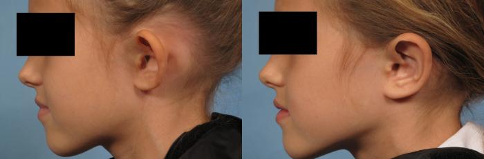 Before & After Otoplasty Case 262 View #3 View in Naples and Ft. Myers, FL