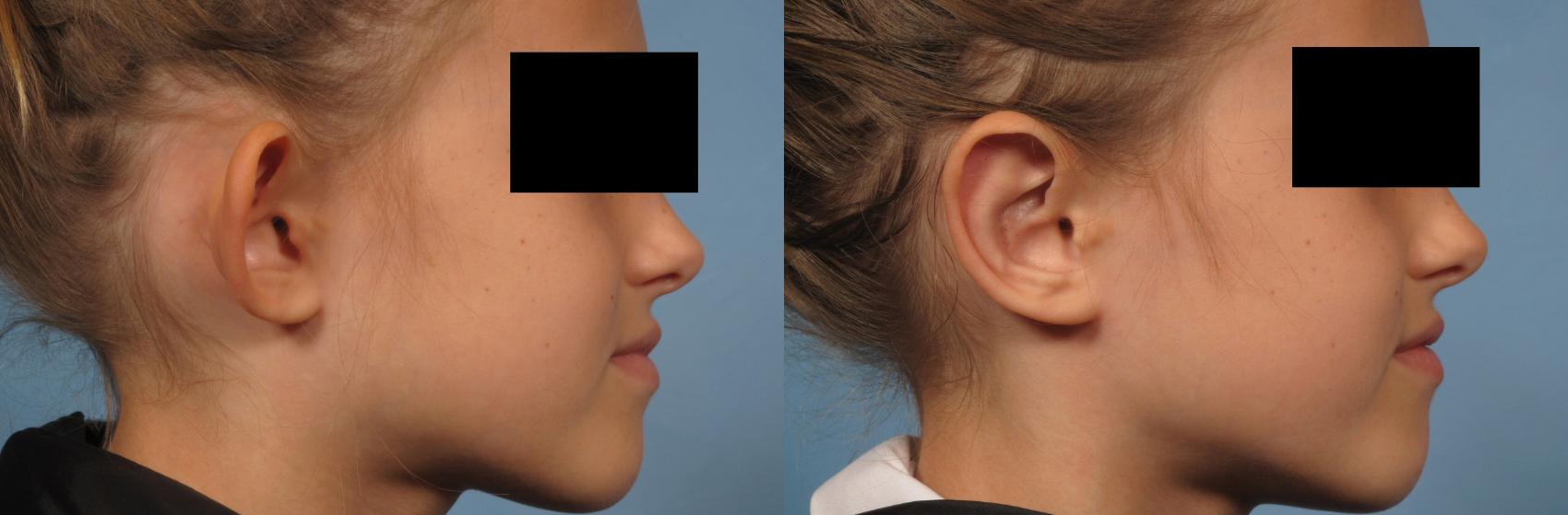 Before & After Otoplasty Case 262 View #4 View in Naples, FL