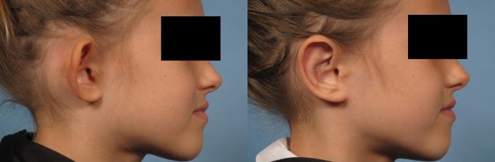 Before & After Otoplasty Case 262 View #4 View in Naples and Ft. Myers, FL