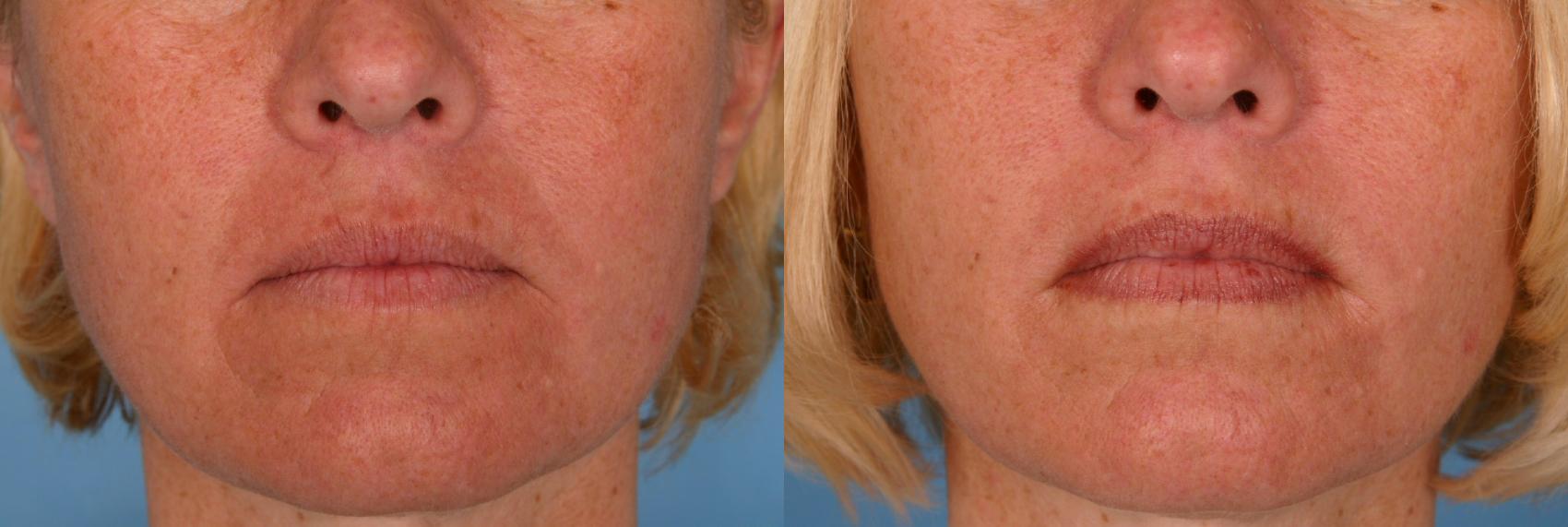 Before & After Radiesse® Case 26 View #1 View in Naples, FL
