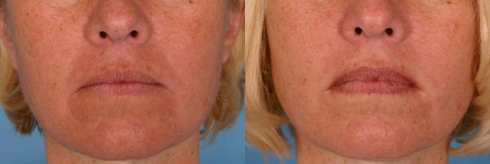 Before & After Radiesse® Case 26 View #1 View in Naples and Ft. Myers, FL