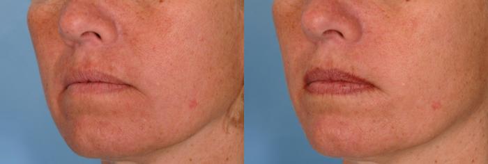 Before & After Radiesse® Case 26 View #2 View in Naples and Ft. Myers, FL