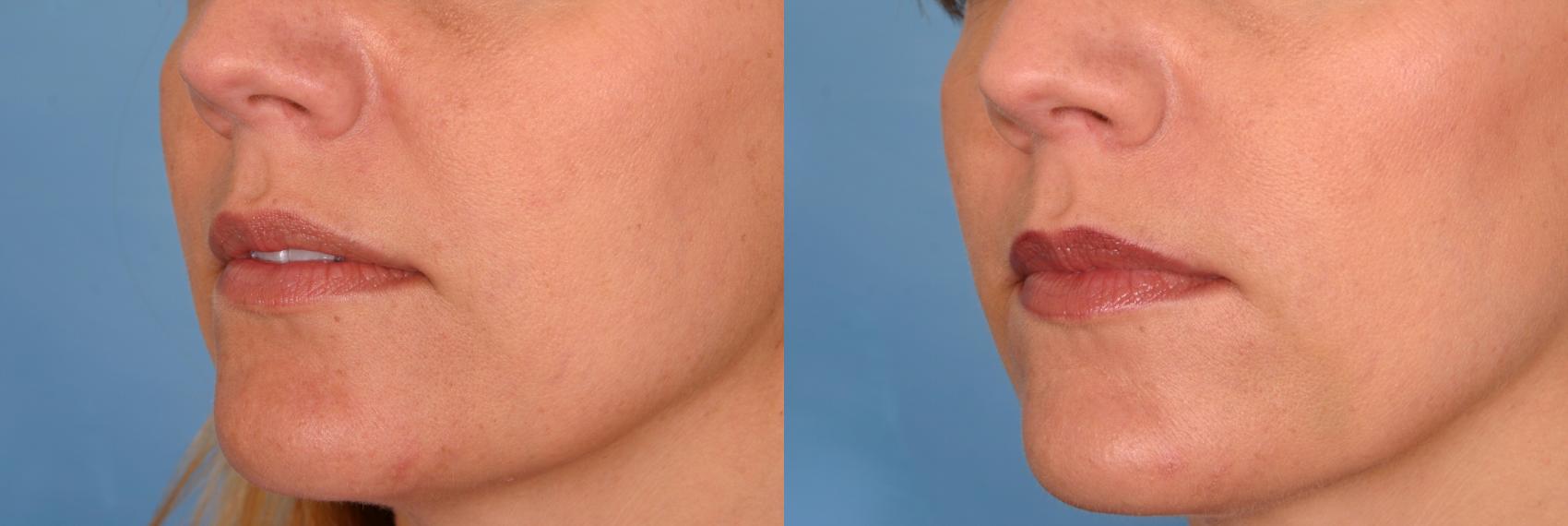 Before & After Radiesse® Case 27 View #1 View in Naples and Ft. Myers, FL