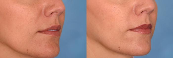 Before & After Radiesse® Case 27 View #2 View in Naples and Ft. Myers, FL