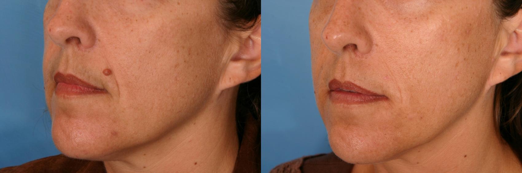 Before & After Radiesse® Case 61 View #1 View in Naples, FL