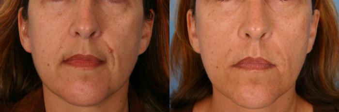 Before & After Radiesse® Case 61 View #2 View in Naples and Ft. Myers, FL