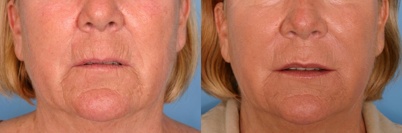 Before & After Radiesse® Case 80 View #1 View in Naples and Ft. Myers, FL