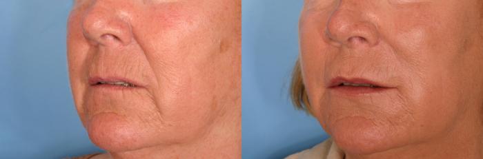 Before & After Radiesse® Case 80 View #2 View in Naples and Ft. Myers, FL