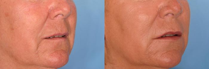 Before & After Radiesse® Case 80 View #3 View in Naples and Ft. Myers, FL
