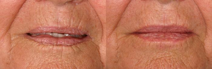 Before & After Radiesse® Case 81 View #1 View in Naples and Ft. Myers, FL