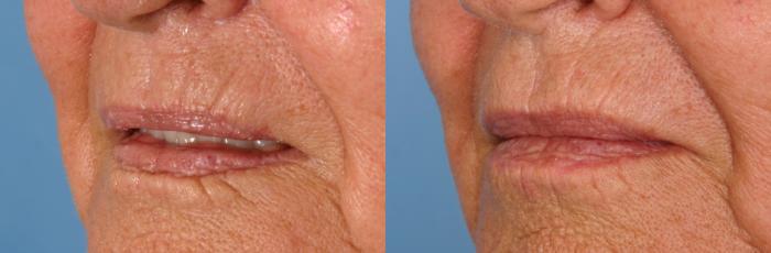 Before & After Radiesse® Case 81 View #2 View in Naples and Ft. Myers, FL