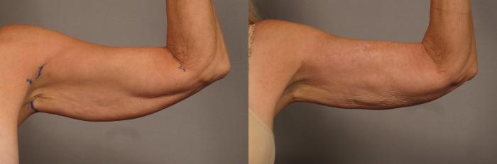 Inside of Left Arm of 59 year old woman before Renuvion and Liposuction