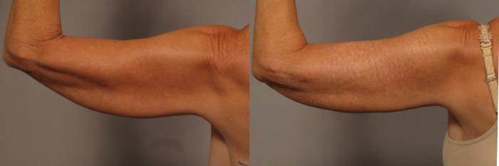 Back of left arm before treatment with liposuction and Renuvion