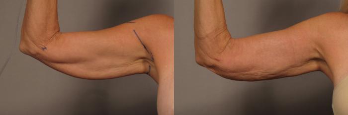 Inside of Right Arm of 59 year old woman before Renuvion and Liposuction