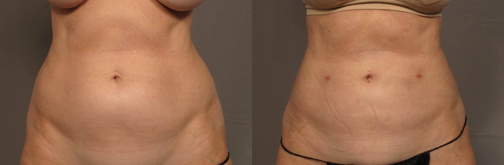 Frontal View of 59 year old Woman Before Renuvion and Liposuction to the Tummy