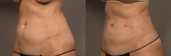 Left Oblique View of 59-year-old Woman Before Renuvion and Liposuction to the Tummy