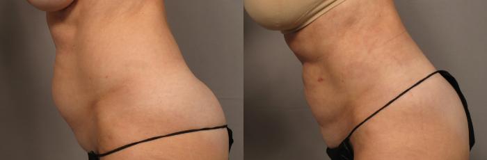 Left Side View of 59-year-old Woman Before Renuvion and Liposuction to the Tummy