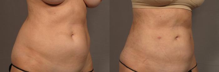 Right Oblique View of 59-year-old Woman Before Renuvion and Liposuction to the Tummy