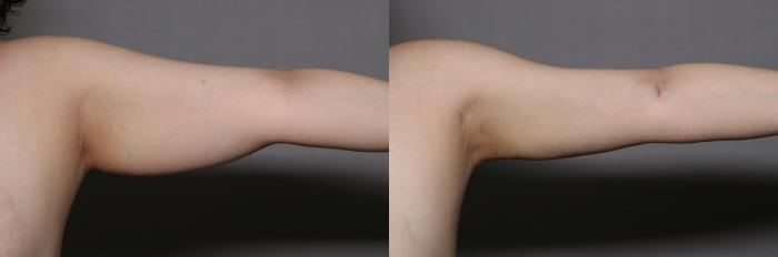 Before Liposuction and Renuvion Skin Tightening of Left Arm