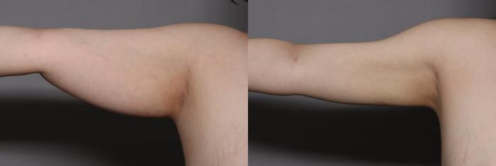 Before Liposuction and Renuvion Skin Tightening of Right Arm