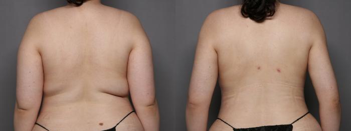 Before Renuvion and Liposuction of the Back and Arms