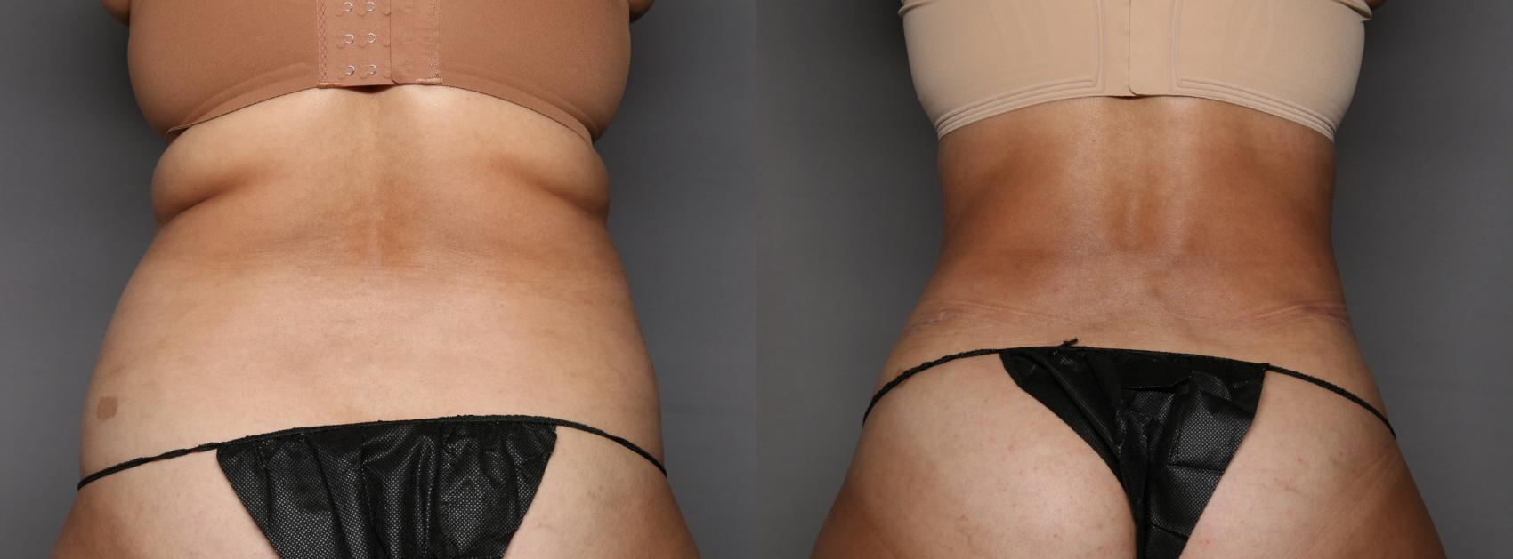 Before Renuvion and Liposuction of the Back by Dr. Hasen
