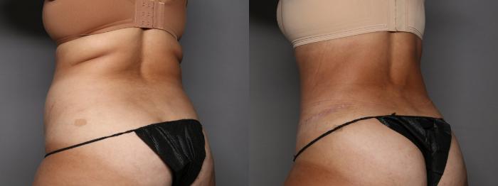 Before Renuvion and Liposuction of back, Left Oblique View