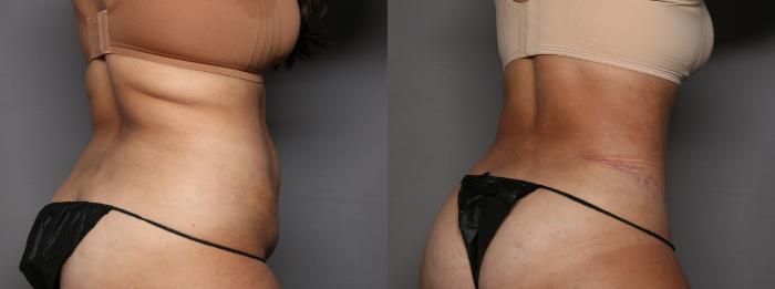 Before Renuvion and Liposuction of the Back, Right Oblique View