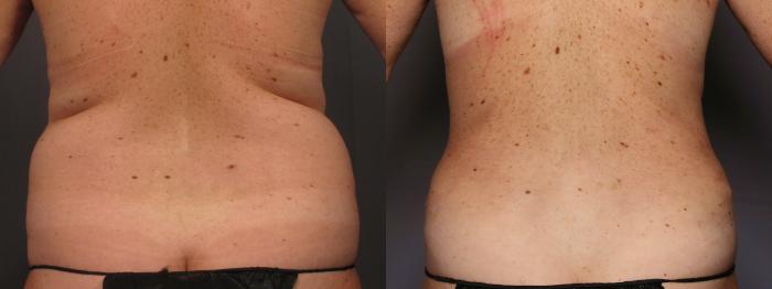 Before Renuvion and Liposuction of the Back