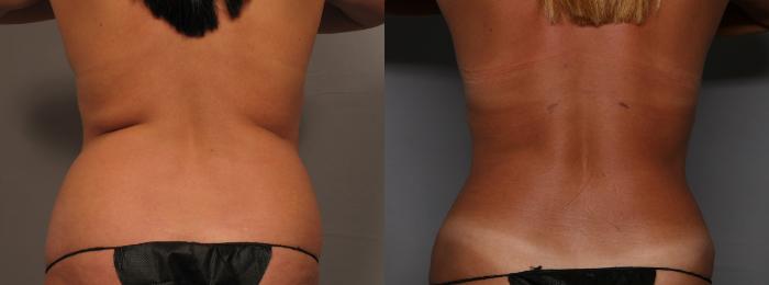 Before Renuvion Skin Tightening with Lipo of the Back, Posterior View