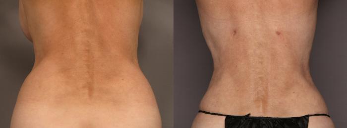 Before Renuvion with Liposuction Body Contouring of the Back