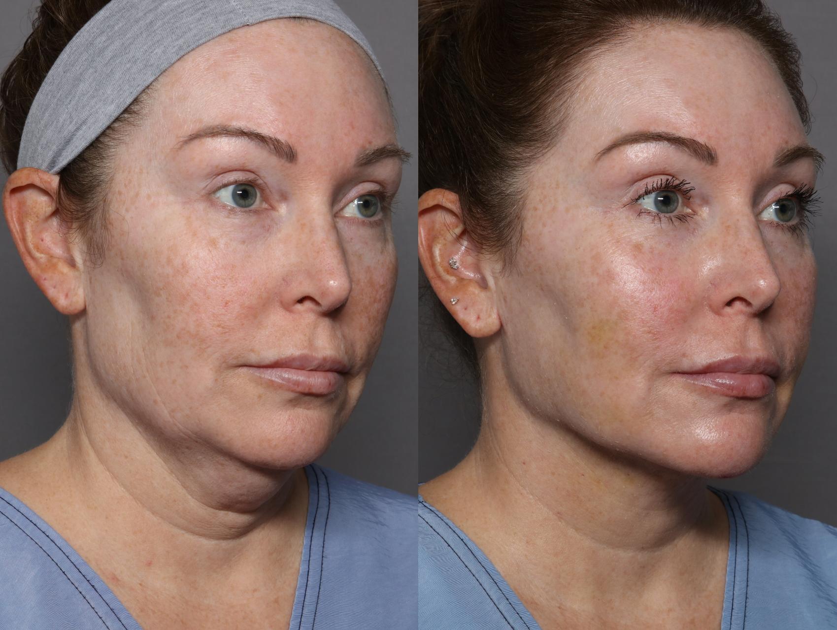 Before Renuvion with Liposuction, Lower Face and Neck Lift, Right Oblique
