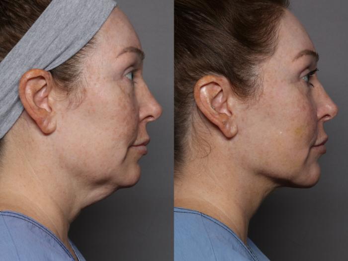 Before Renuvion with Liposuction, Lower Face and Neck Lift, Right Side