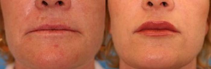 Before & After Restylane® Case 13 View #1 View in Naples and Ft. Myers, FL