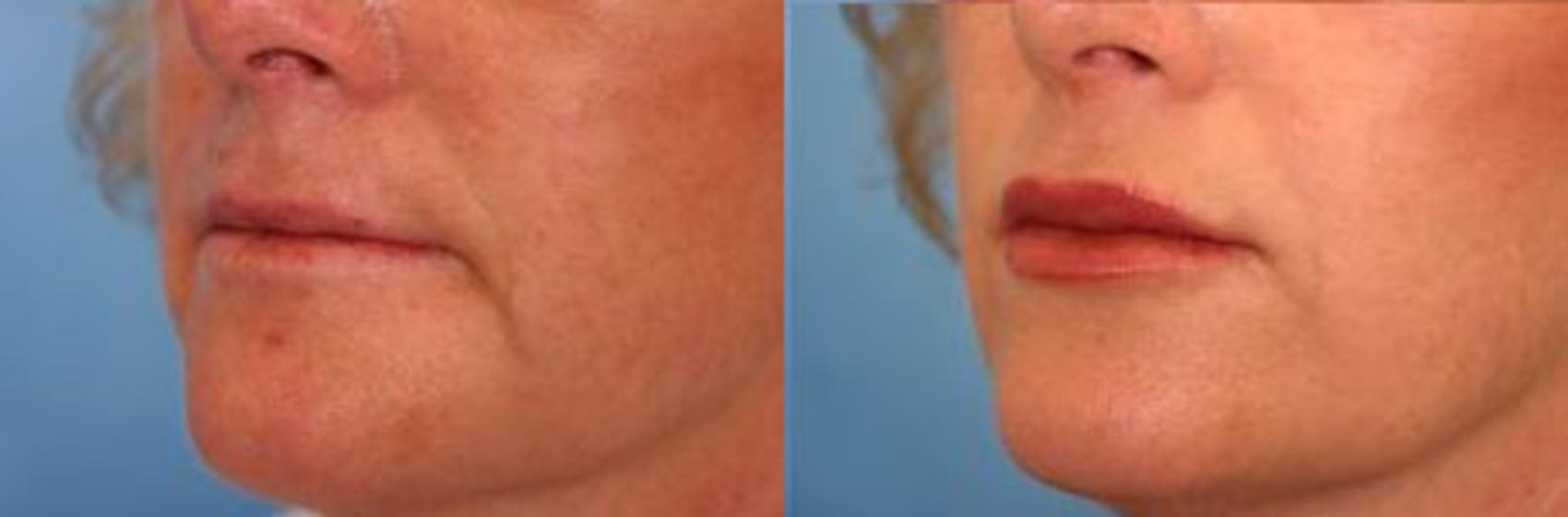 Before & After Restylane® Case 13 View #2 View in Naples and Ft. Myers, FL