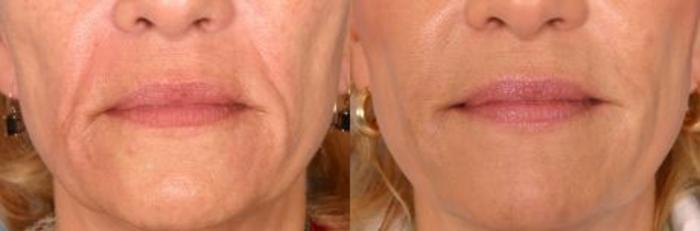 Before & After Restylane® Case 14 View #1 View in Naples and Ft. Myers, FL