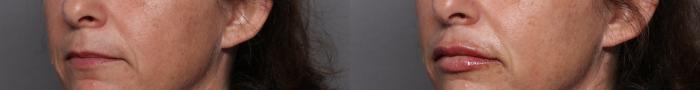 Left Oblique View Before 1cc of Restylane Kysse Lip Filler