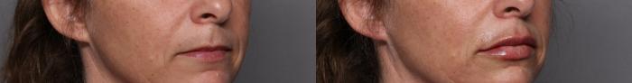 Right Oblique View Before 1cc of Restylane Kysse Filler