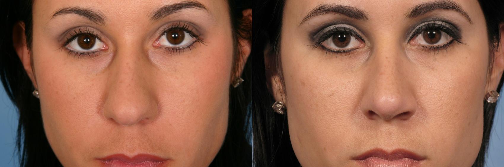 Before & After Rhinoplasty (Nose Reshaping) Case 127 View #1 View in Naples and Ft. Myers, FL