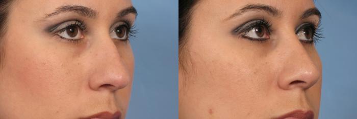 Before & After Rhinoplasty (Nose Reshaping) Case 127 View #2 View in Naples and Ft. Myers, FL