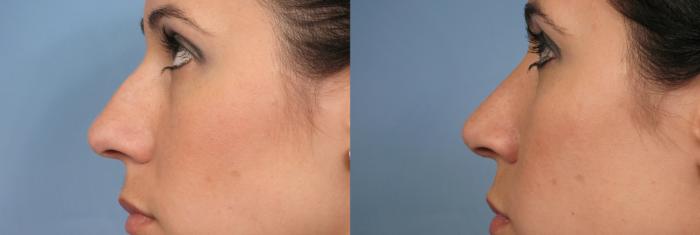 Before & After Rhinoplasty (Nose Reshaping) Case 127 View #3 View in Naples and Ft. Myers, FL