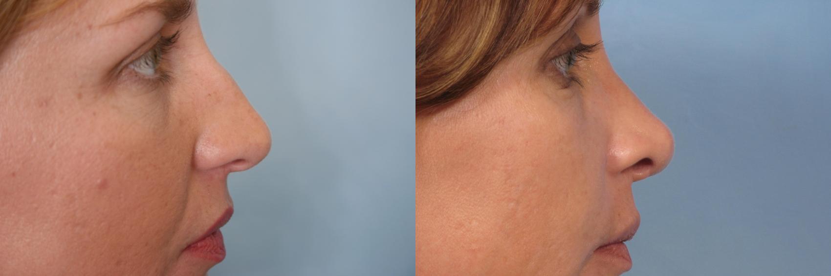 Before & After Rhinoplasty (Nose Reshaping) Case 128 View #1 View in Naples and Ft. Myers, FL