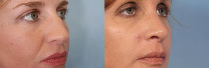 Before & After Rhinoplasty (Nose Reshaping) Case 128 View #2 View in Naples and Ft. Myers, FL