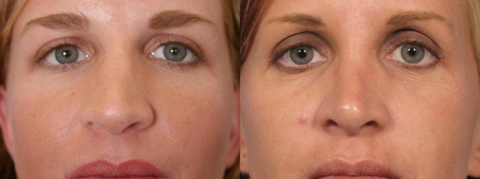 Before & After Rhinoplasty (Nose Reshaping) Case 128 View #3 View in Naples and Ft. Myers, FL