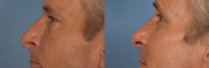 Before & After Rhinoplasty (Nose Reshaping) Case 129 View #1 View in Naples and Ft. Myers, FL