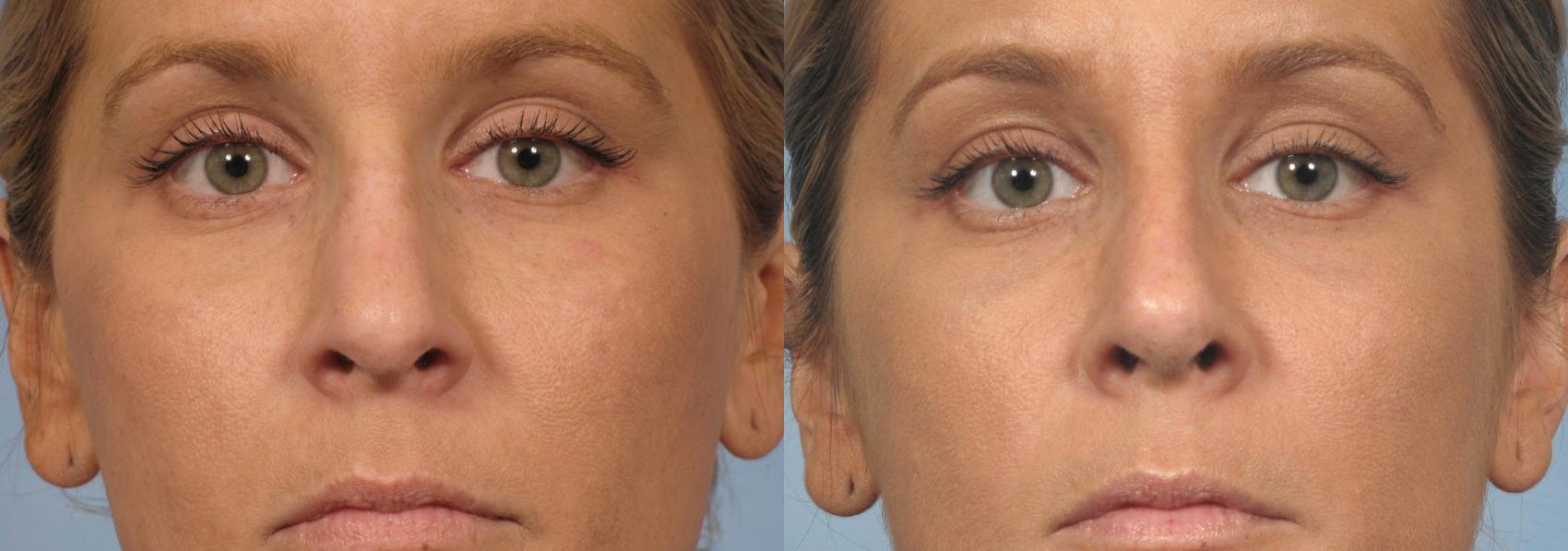 Before & After Rhinoplasty (Nose Reshaping) Case 134 View #1 View in Naples and Ft. Myers, FL
