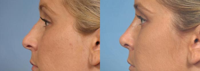 Before & After Rhinoplasty (Nose Reshaping) Case 134 View #2 View in Naples and Ft. Myers, FL
