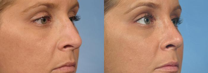 Before & After Rhinoplasty (Nose Reshaping) Case 134 View #3 View in Naples and Ft. Myers, FL