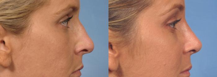 Before & After Rhinoplasty (Nose Reshaping) Case 134 View #4 View in Naples and Ft. Myers, FL